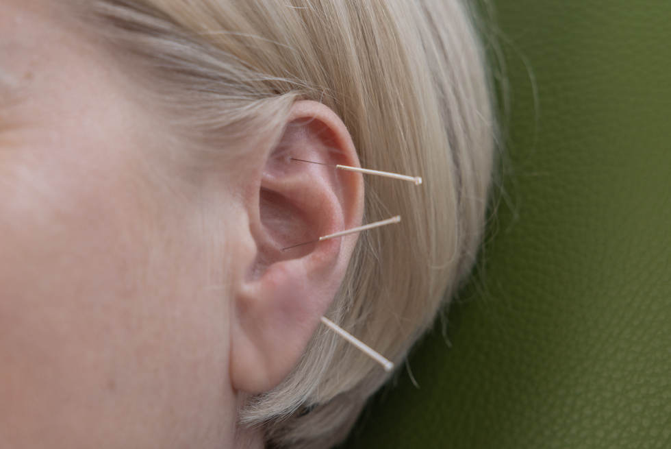 Detailaufnahme: Frauenohr mit drei Akupunkturnadeln